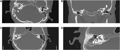 Bacterial and Fungal Infections Promote the Bone Erosion Progression in Acquired Cholesteatoma Revealed by Metagenomic Next-Generation Sequencing